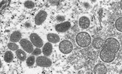 Monkeypox Not Found in Azerbaijan Amidst Global Concerns